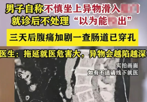 医疗专家警示：直肠异物滞留风险攀升，延误就医恐致严重并发症